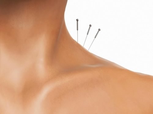 acupuntura