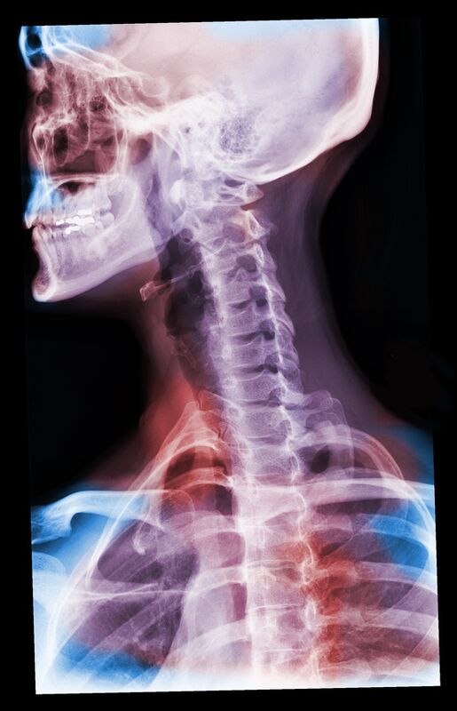 lesión cervical - cuello en gimnasio